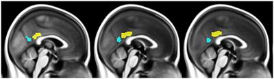 Connectivity Disruption, Atrophy, and Hypometabolism within Posterior Cingulate Networks in Alzheimer's Disease